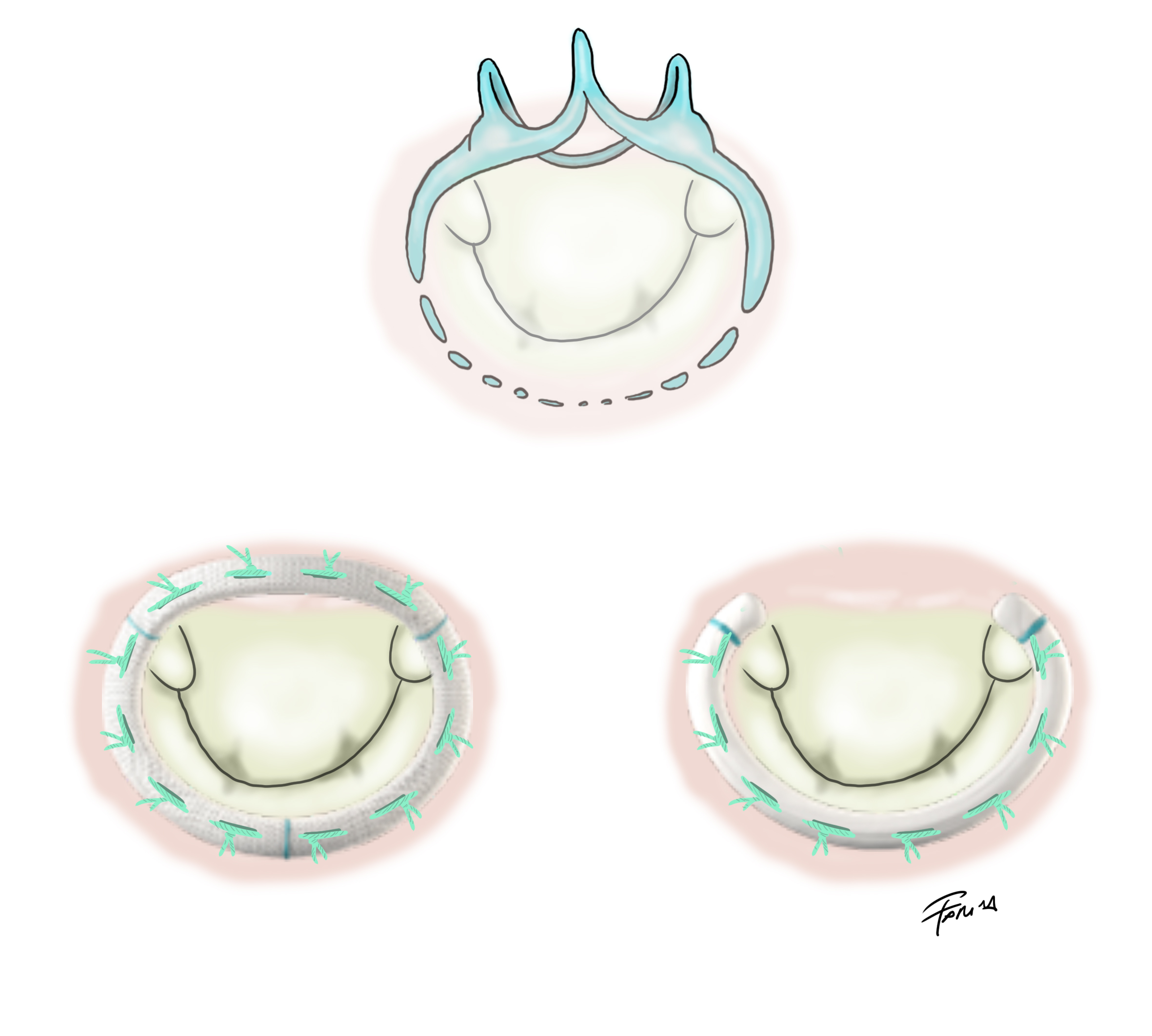 Anelli per la riparazione mitralica