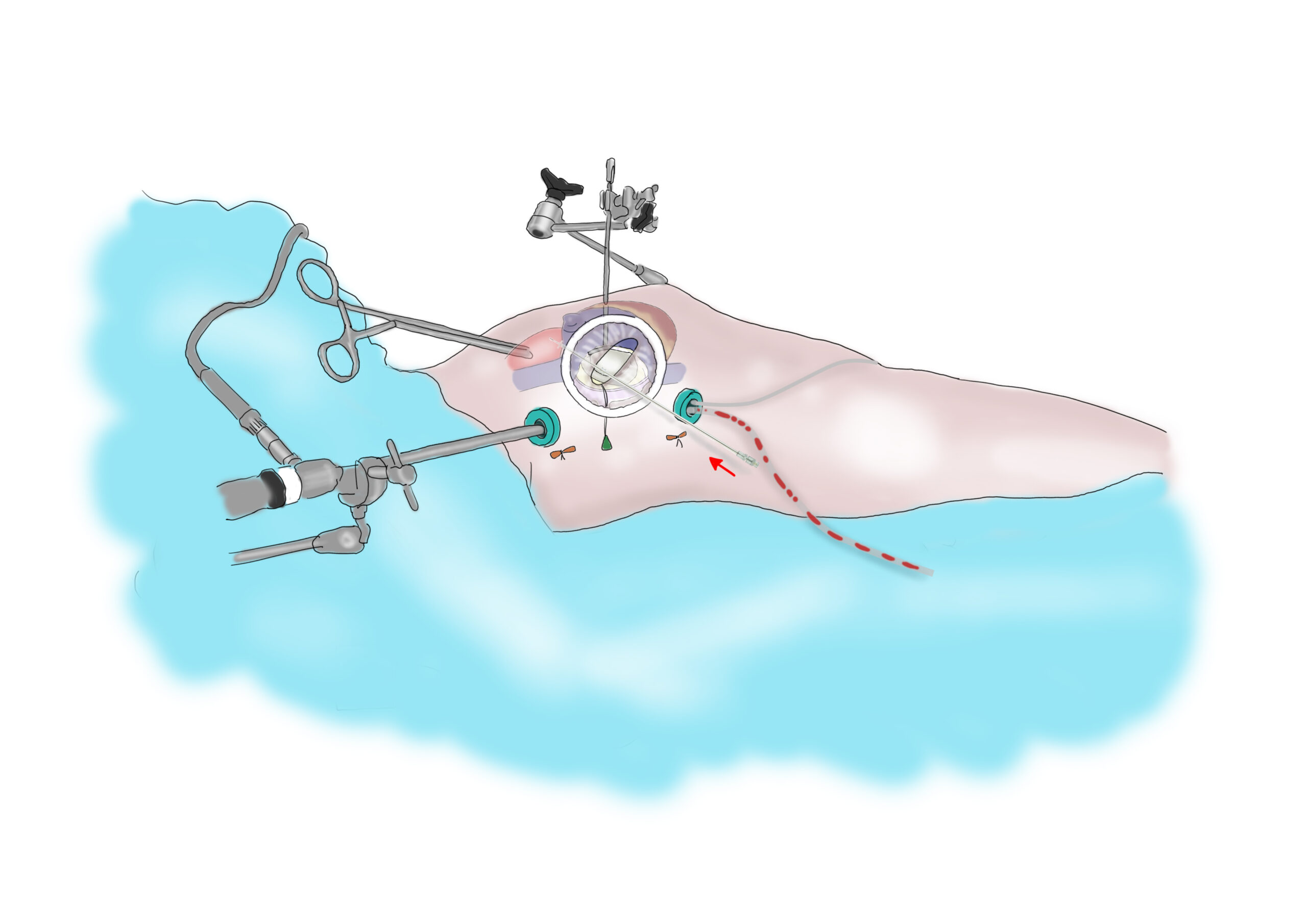 Chirurgia mitralica in minitoracotomia destra