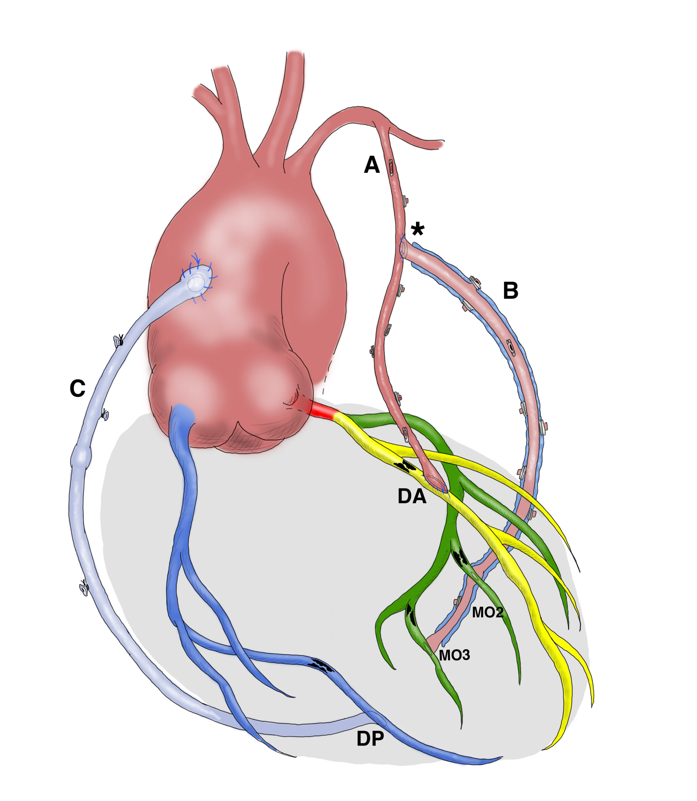 Tipi di graft per il bypass