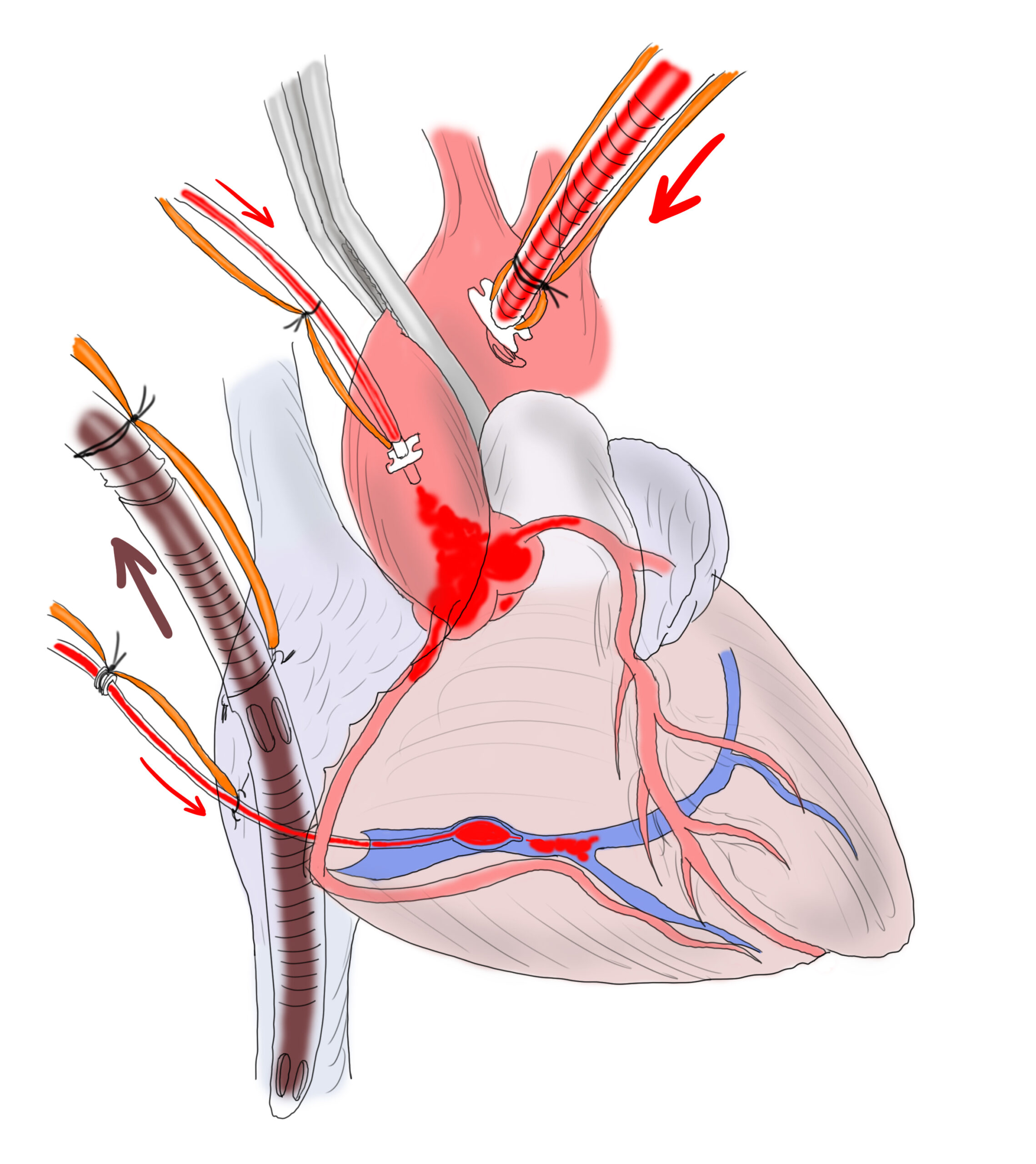 Siti di cannulazione