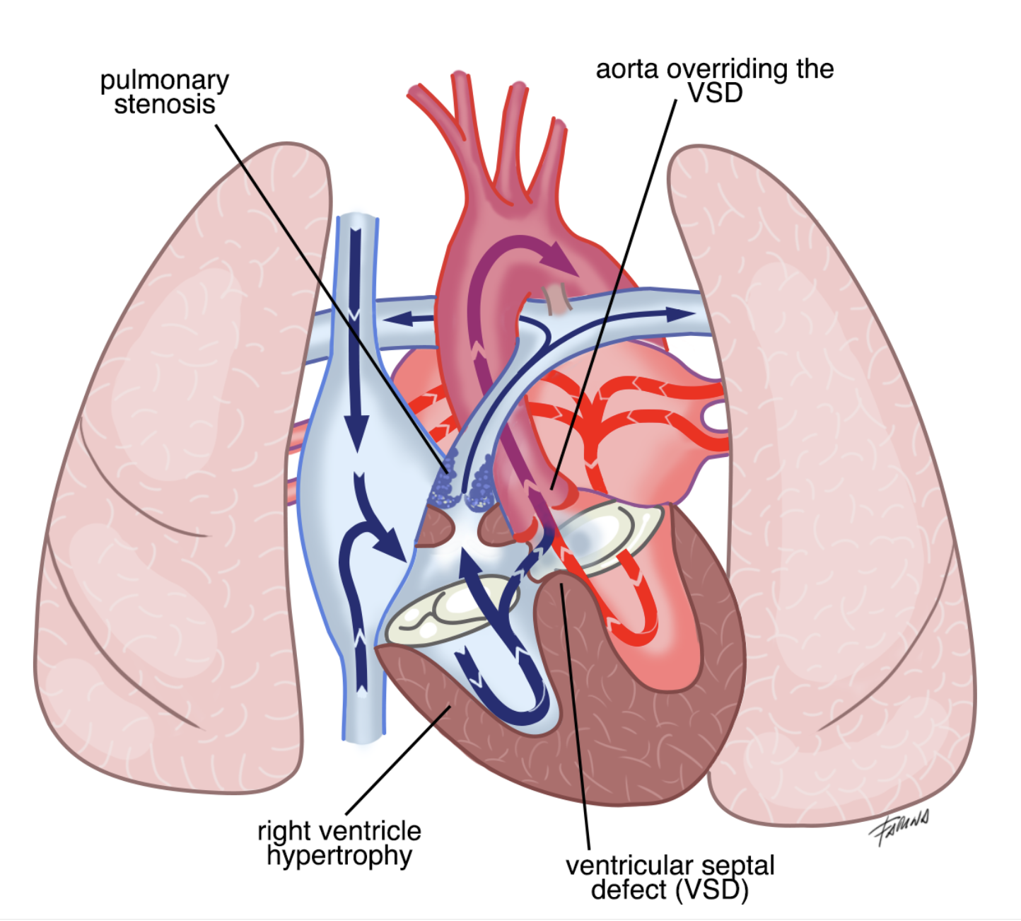 Tetralogia di Fallot