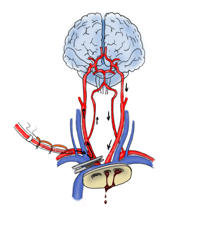 Protezione cerebrale durante chirurgia dell’arco aortico