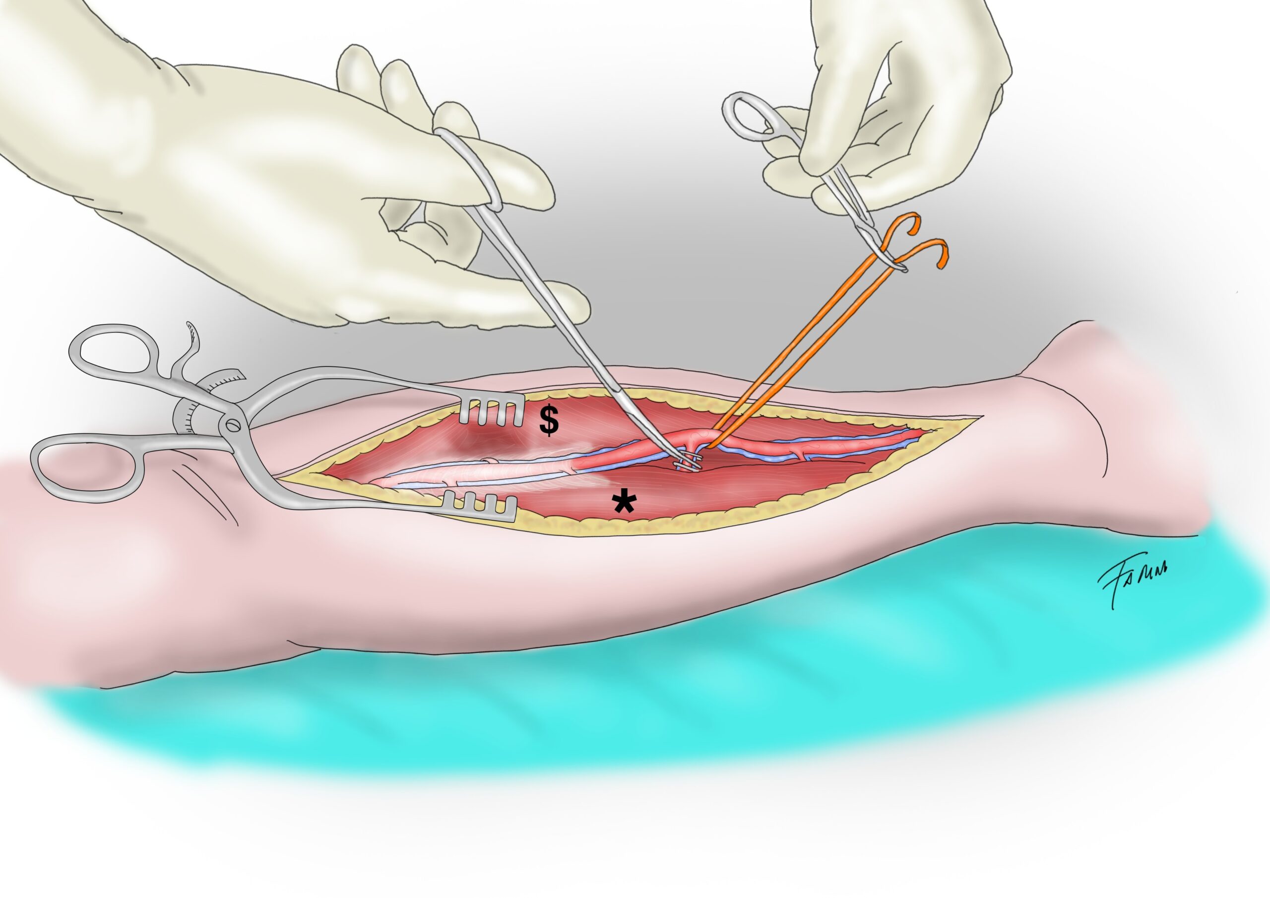 Prelievo dei condotti per il bypass