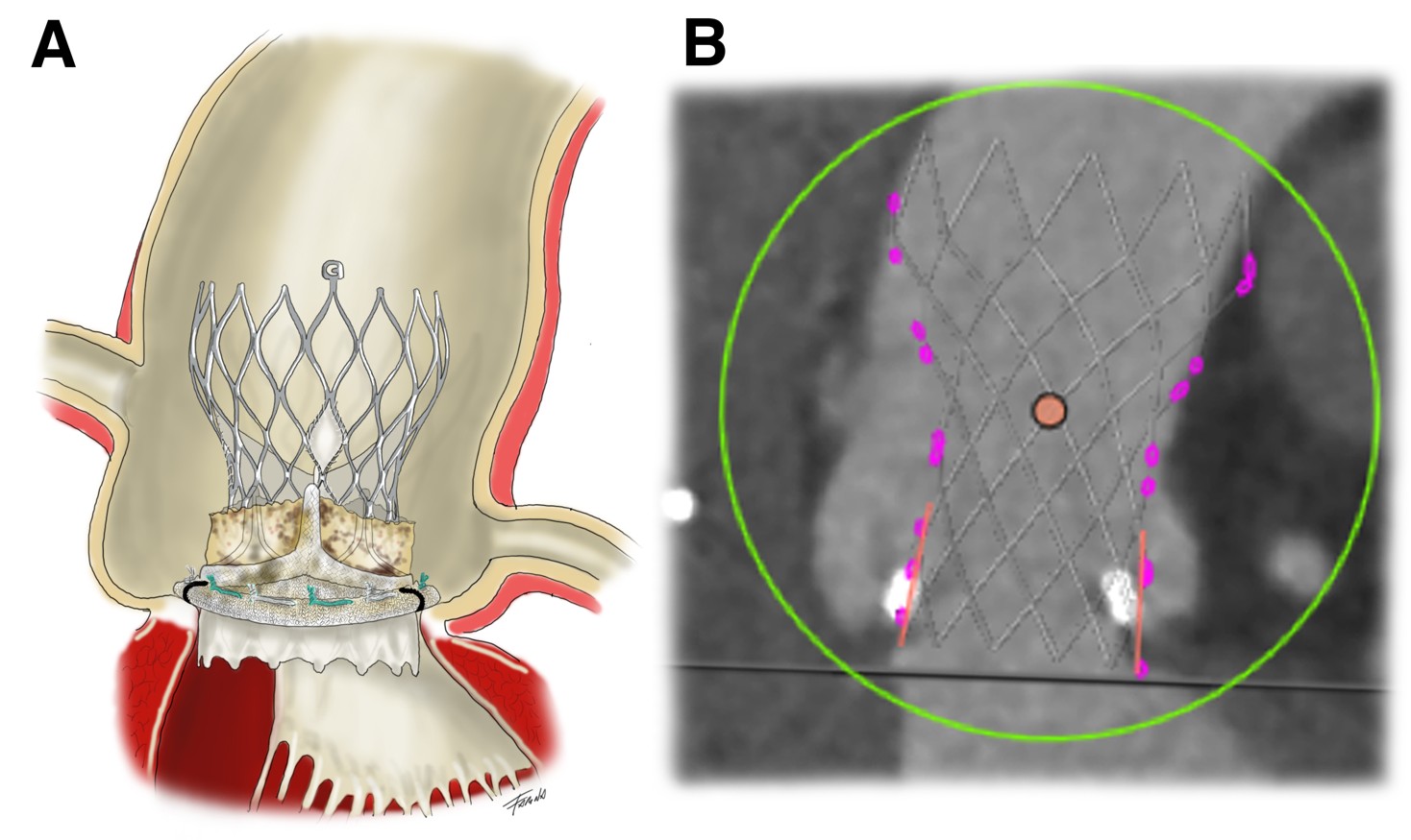 TAVI per disfunzione di bioprotesi