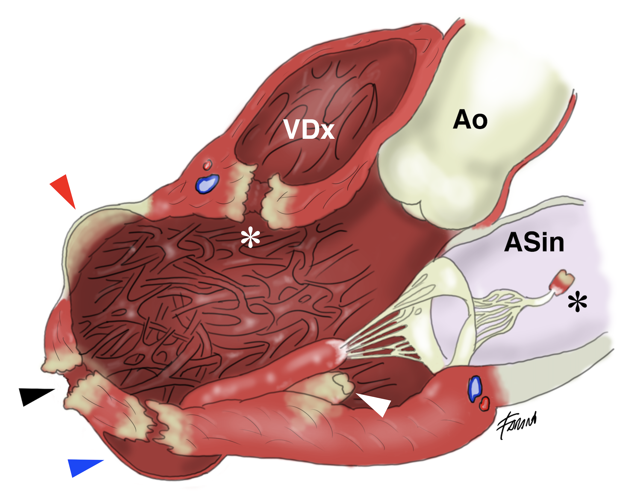 Complicanze meccaniche dell’infarto