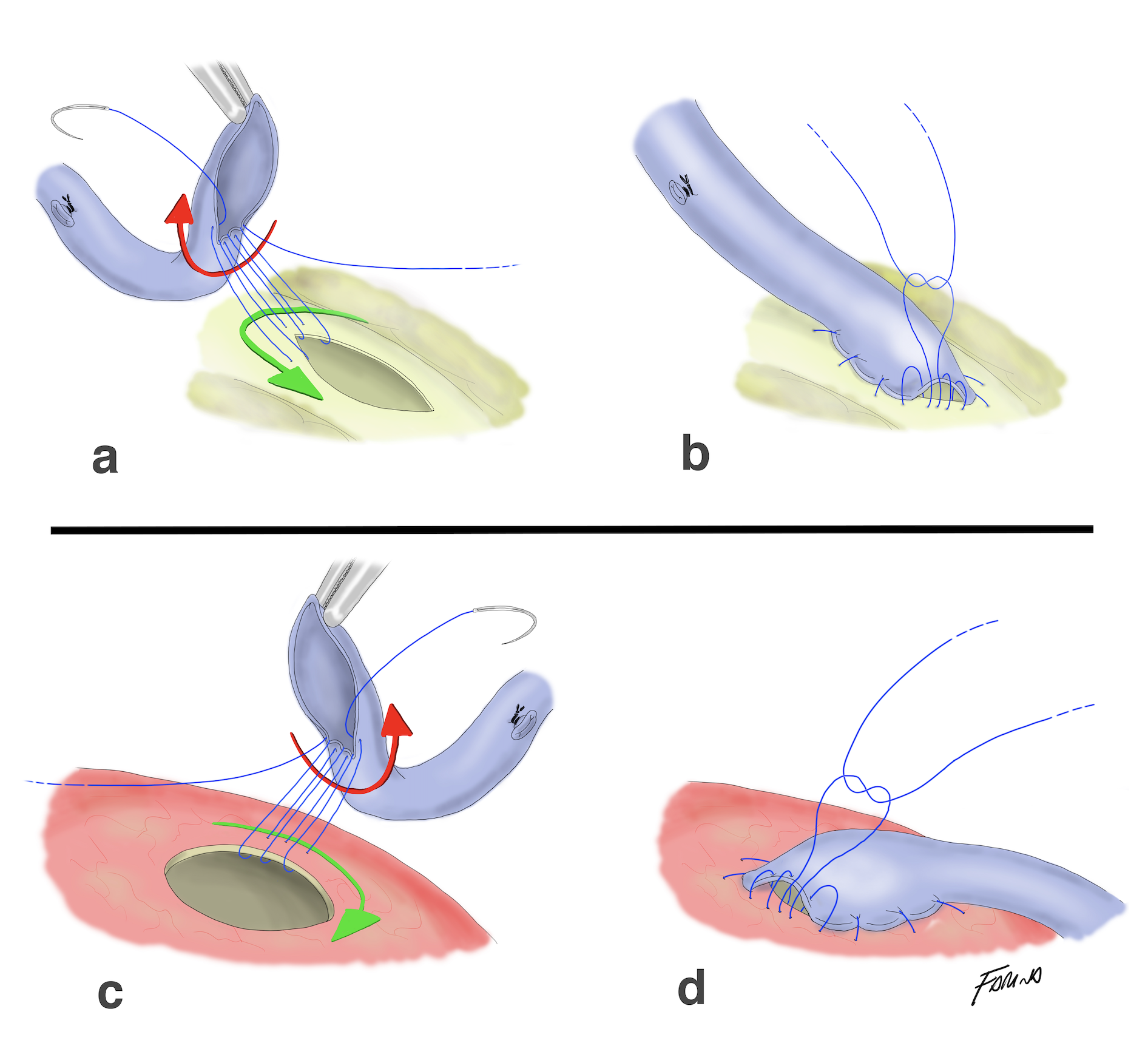 Anastomosi per bypass
